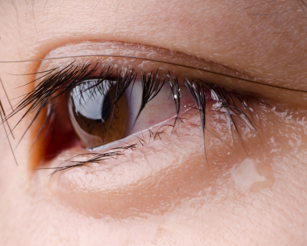 Olhos marejados de secura • PANACEA